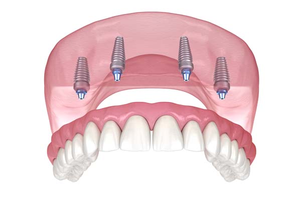 What Is All-on-4® and How Can It Replace Missing Teeth? - Hyde Park