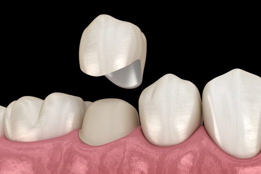 Why You May Need A Dental Crown After Root Canal Therapy