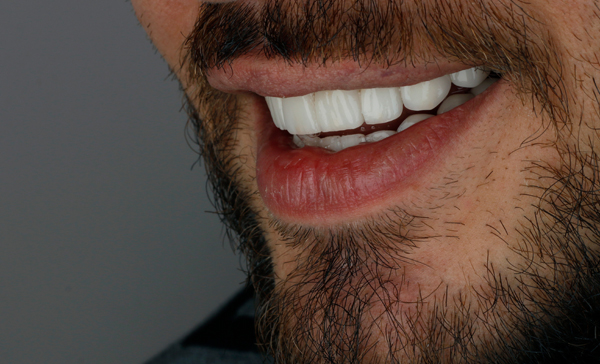 When You May Need Dental Core Buildup Before A Dental Crown