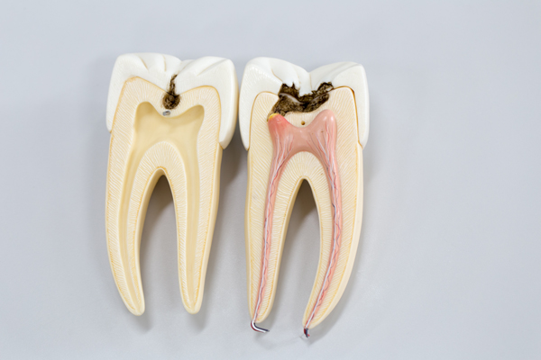 How Long Does It Take To Recover From A Root Canal?