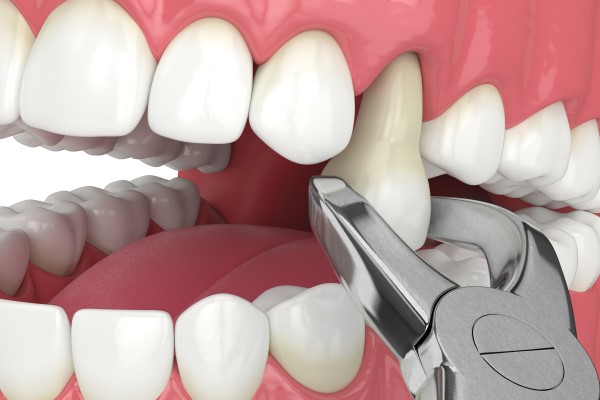 Can A General Dentist Perform A Tooth Extraction?